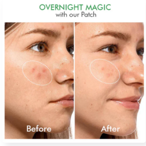 Hydrocolloid Acne Patches Clear Overnight Patches