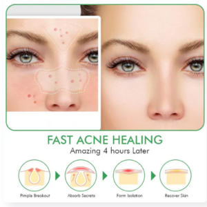 Hydrocolloid Acne Patches Clear Overnight Patches