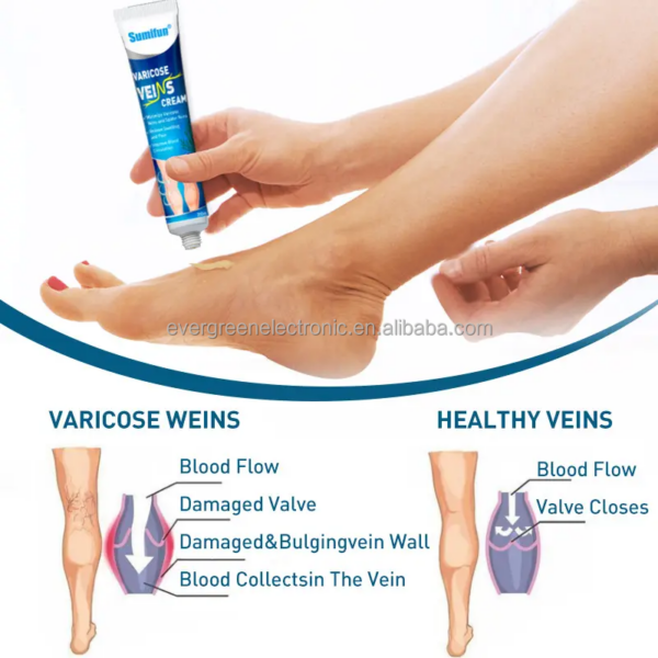 Banish™ Varicose Veins with Our Powerful Miracle Cream!