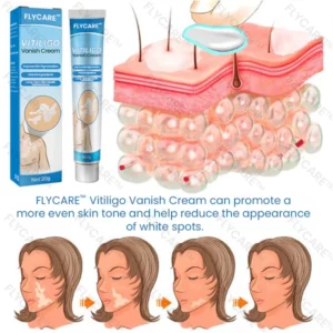 FLYCARE™ Vitiligo Vanish Cream