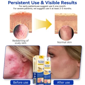 LOVILDS™ PsoriaHeal Bee Poison Psoriasis Treatment Spray pro