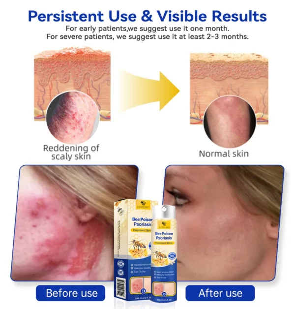 LOVILDS™ PsoriaHeal Bee Poison Psoriasis Treatment Spray pro