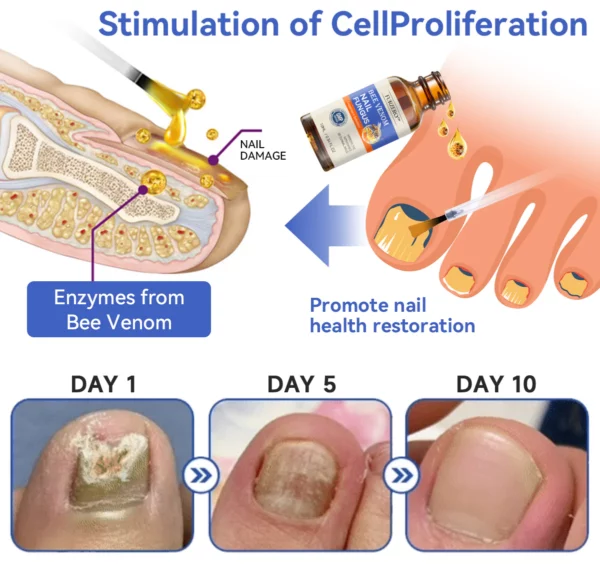 Furzero™ Bee Venom Nail Fungus Treatment: Restore Nail Health