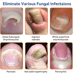 Furzero™ Bee Venom Nail Fungus Treatment: Restore Nail Health