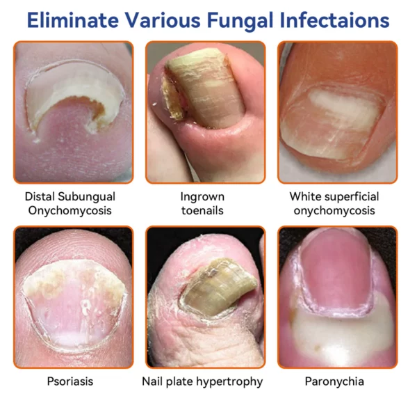 Furzero™ Bee Venom Nail Fungus Treatment: Restore Nail Health