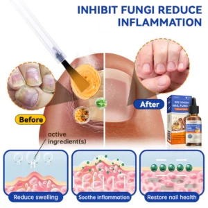 Furzero™ Bee Venom Nail Fungus Treatment: Restore Nail Health