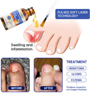 Furzero™ Bee Venom Nail Fungus Treatment: Restore Nail Health