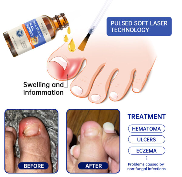 Furzero™ Bee Venom Nail Fungus Treatment: Restore Nail Health