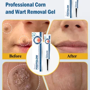 Professional Corn and Wart Removal Gel