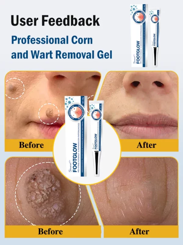 Professional Corn and Wart Removal Gel