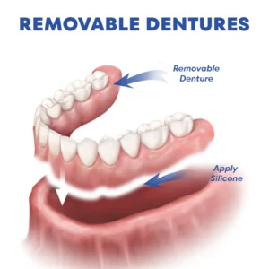 LOVILDS™Thermoplastic Denture Adhesive