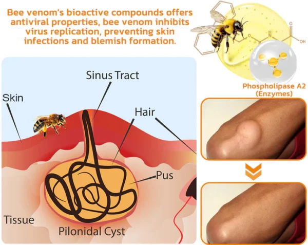 Awzlove™ Bee Venom Lipomas Therapy Cream