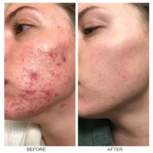 LIMETOW™ Herbal Acne Removal Cream