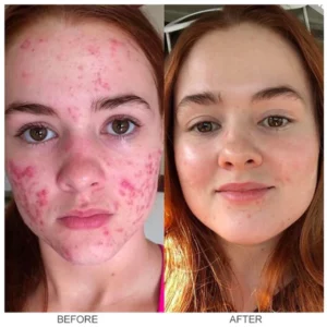 LIMETOW™ Herbal Acne Removal Cream