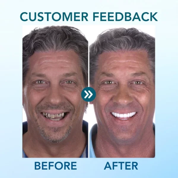 Fivfivgo™ Snap-In Dentures