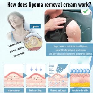 Easily relieve subcutaneous lump lipoma