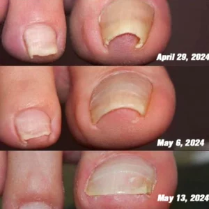 Furzero™ Bee Venom Nail Fungus Treatment: Restore Nail Health