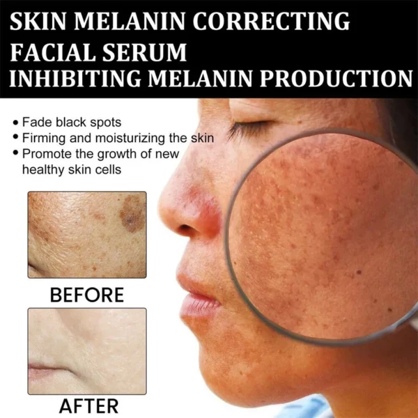 Fast Dark Spot Remover-LOVILDS™ Melanin Correcting Facial Serum