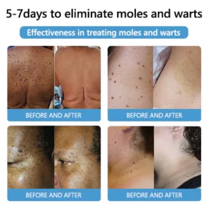 LOVILDS™ Bee Poison Mole and Wart Treatment Cream