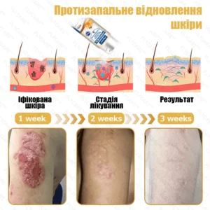 Professional remedy against psoriasis on the body