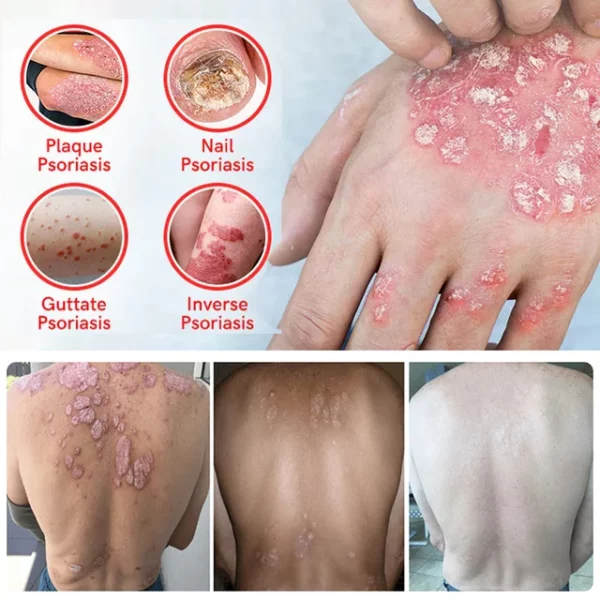 Multi-Symptom Psoriasis Care Anti-Itch Cream