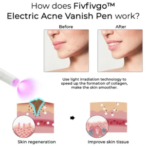 Fivfivgo™ Electric Acne Vanish Pen