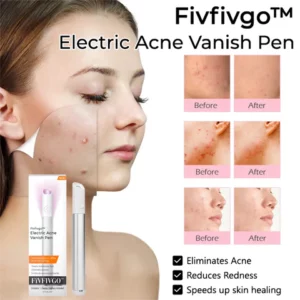 Fivfivgo™ Electric Acne Vanish Pen