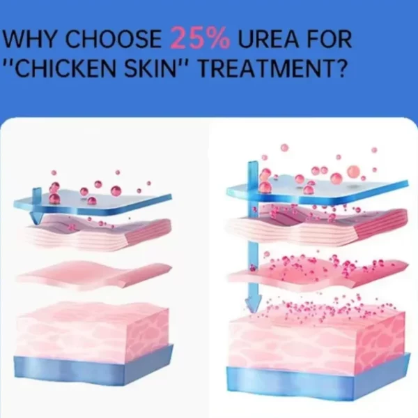 Curing Keratosis Pilaris Chicken Follicle Skin Repair Cream