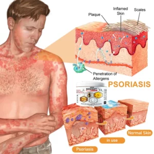 Multi-Symptom Psoriasis Care Anti-Itch Cream