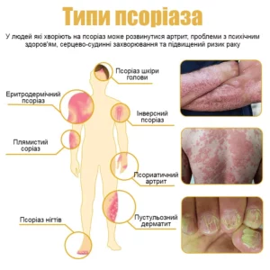 Professional remedy against psoriasis on the body