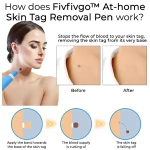 Fivfivgo™ Skin Tag Remover Pen at Home