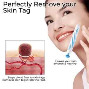 Fivfivgo™ Skin Tag Remover Pen at Home