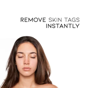 Fivfivgo™ WipeOff Tags & Mole Remover