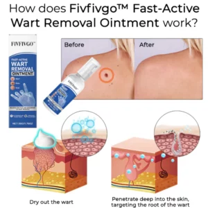 Fivfivgo™ Fast-Active Wart Removal Ointment