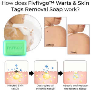 Fivfivgo™ Warts & Skin Tags Removal Soap